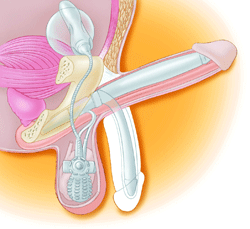 Surgical implant penis