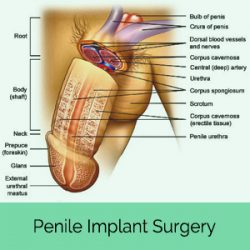 penile implants