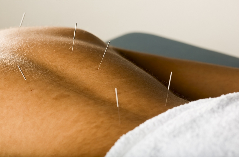 Acupuncture