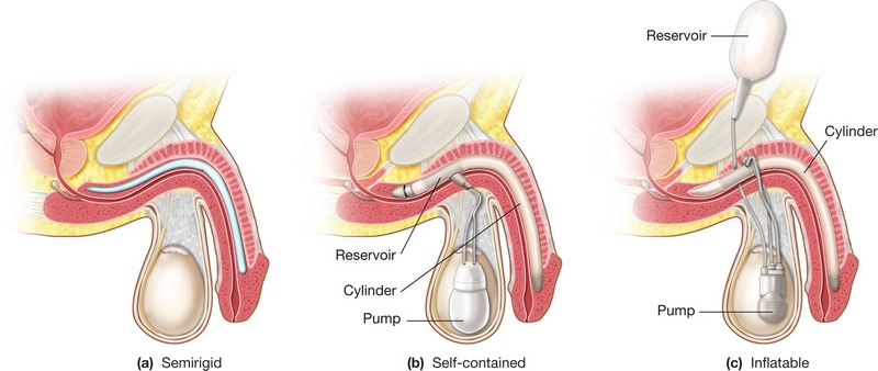 Penile implants