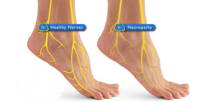 Diabetic Neuropathy