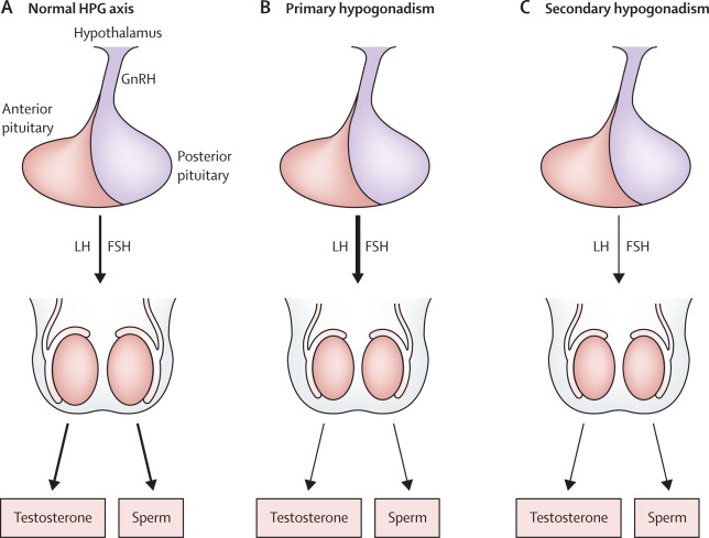 Hypogonadism