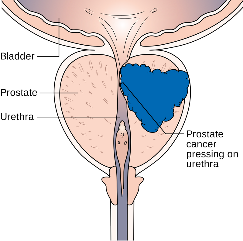 Prostate Cancer