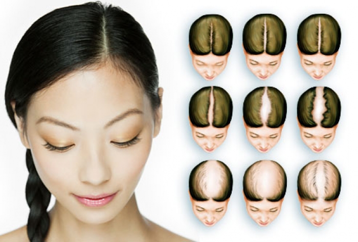 female baldness